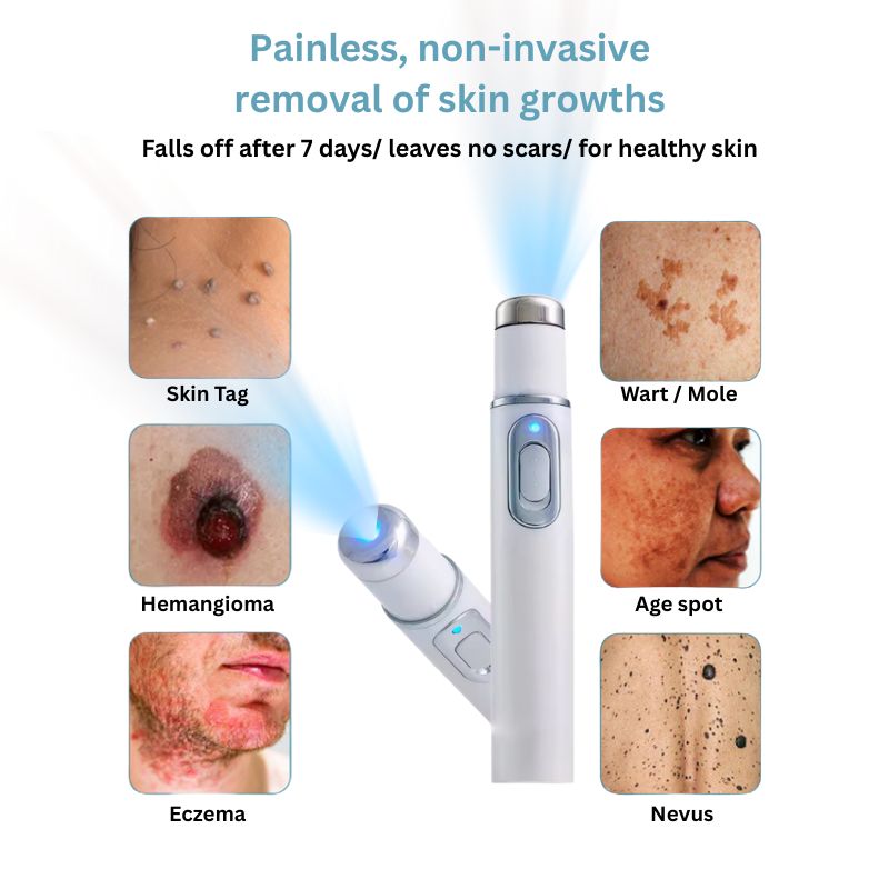 Mole and Wart Removal Laser Pen