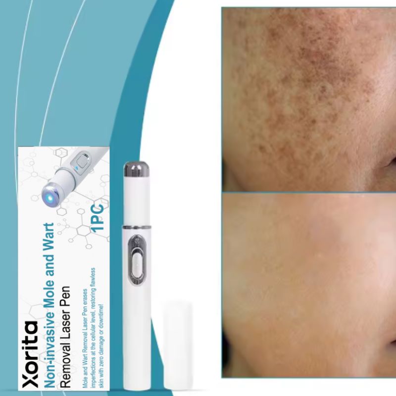 Mole and Wart Removal Laser Pen