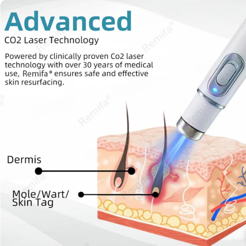 Mole and Wart Removal Laser Pen