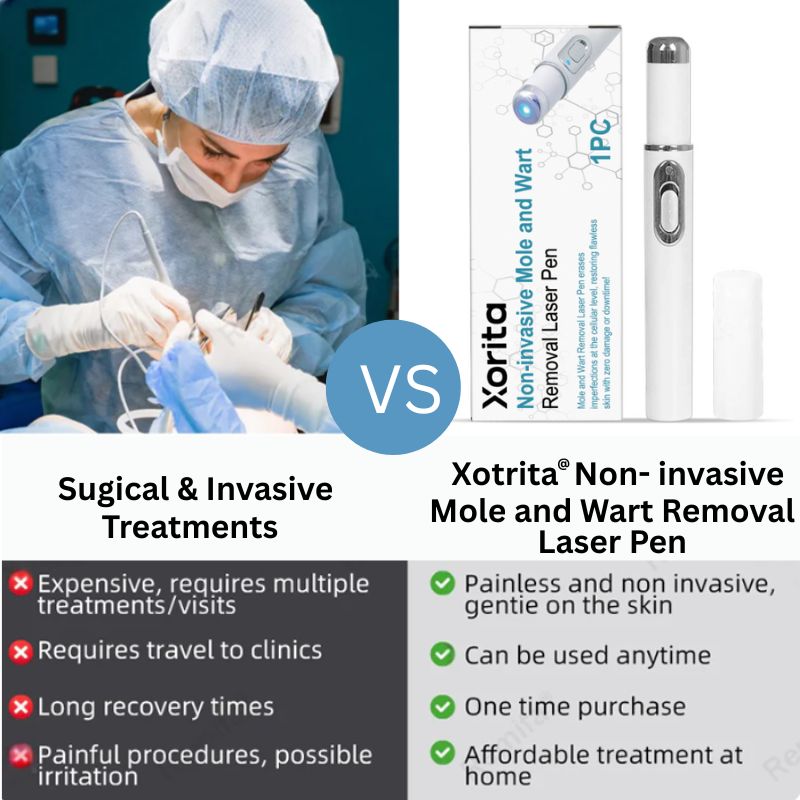 Mole and Wart Removal Laser Pen