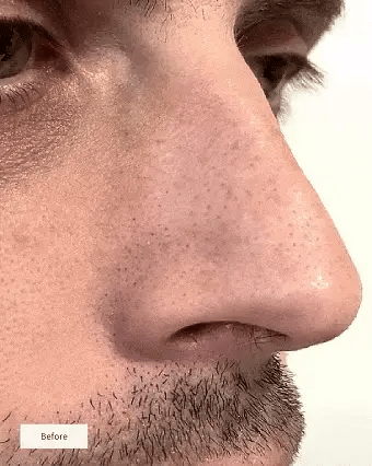 Nose Patches - Unclog and Purify Pores
