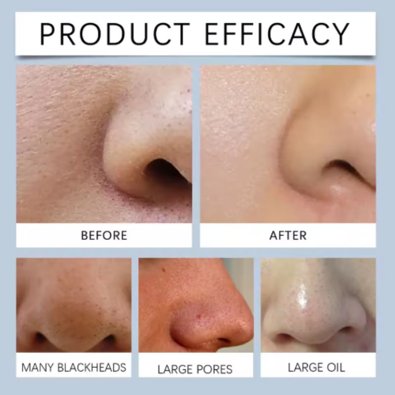 Nose Patches - Unclog and Purify Pores