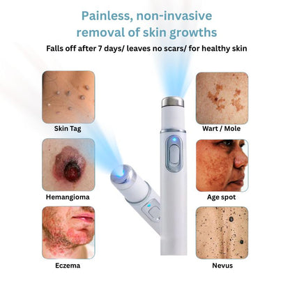Mole and Wart Removal Laser Pen